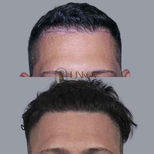 Central Centrifugal Cicatricial Alopecia Treatment in NYC