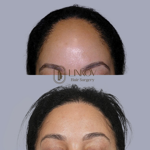 Female Hair Transplant Before and After