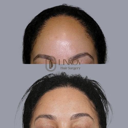 Hair Loss Treatments for Women Before and After