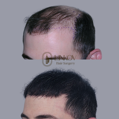 Hair Transplant for Men in NYC Before and After