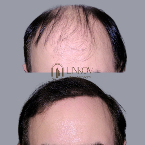 Hair Transplants in New York Before and After