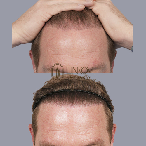 Hair Loss Treatment Before and After