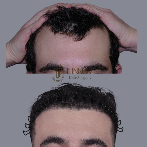 Hair Loss Treatments for Men