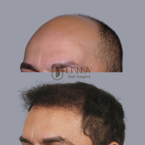 Androgenetic Alopecia