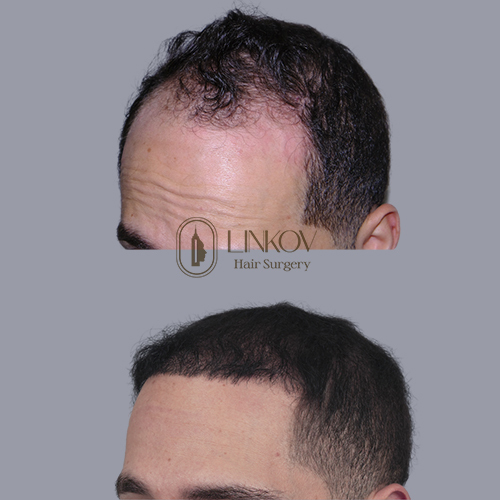 Body Hair Transplant