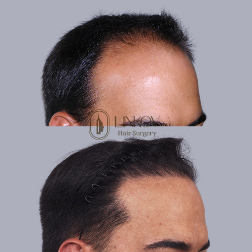 Celebrity Hair Transplants Before and After