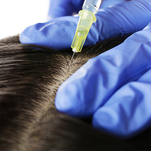 PRP Hair Treatment for Hair Loss in NYC