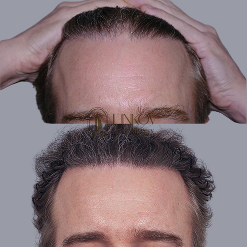 Stem Cell Therapy for Hair Loss