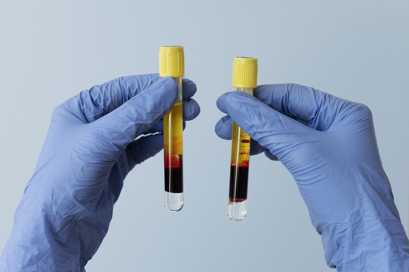 Hands With Gloves Holding Vials PRP